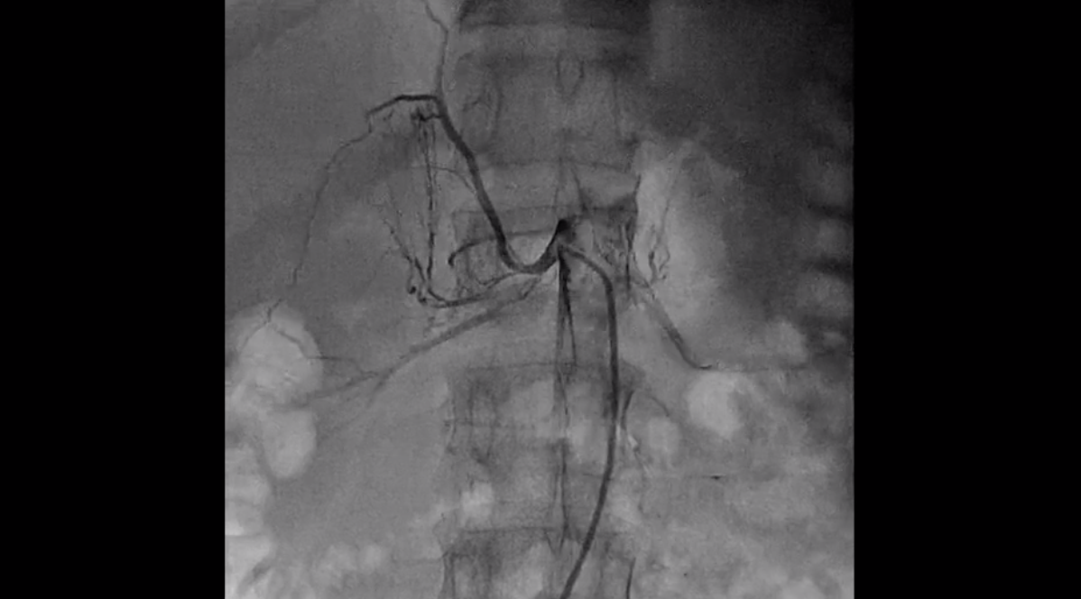 Percutaneous Renal Artery Stenting for Stenosis in a Young Patient